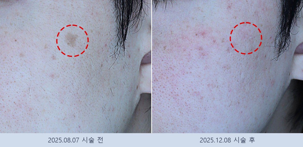 흑자 검버섯