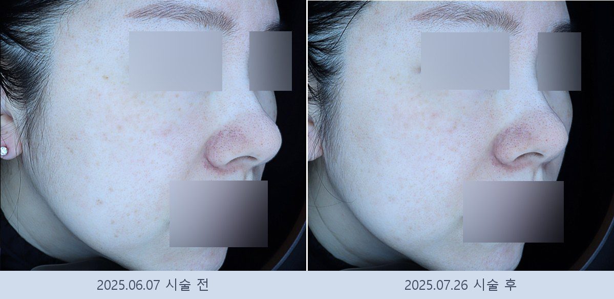 기미 잡티