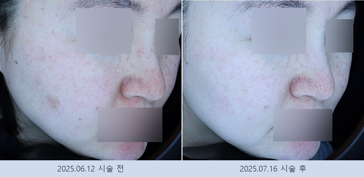 기미 잡티