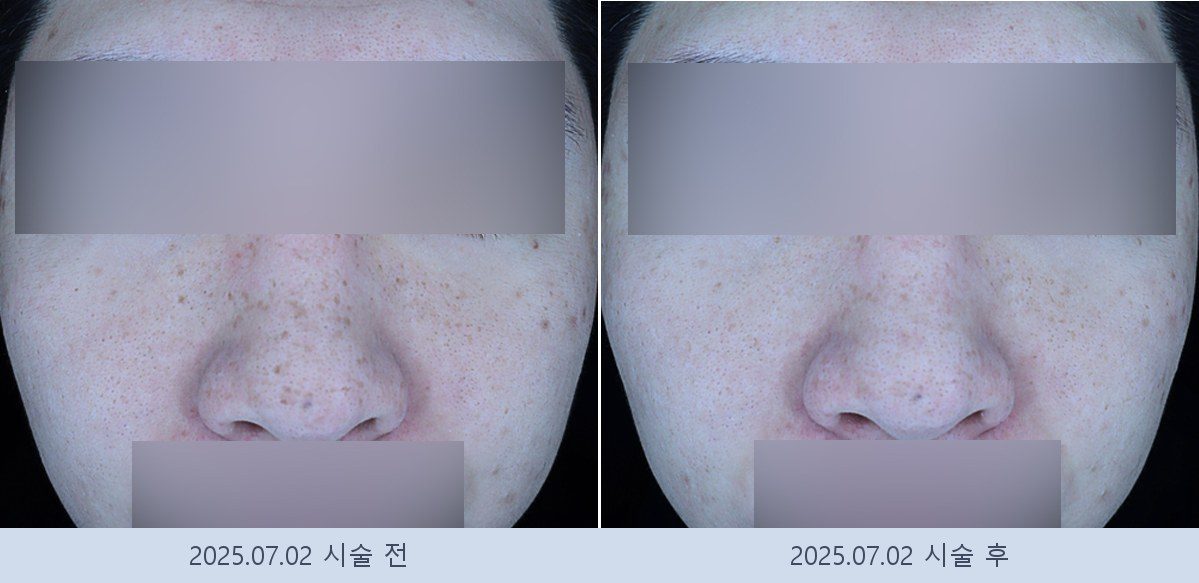 기미 잡티